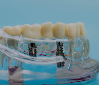 
Qu’est-ce un implant dentaire?
